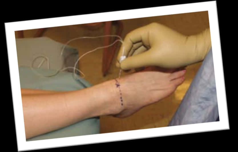 Suturing Wound Care Procedure PNG