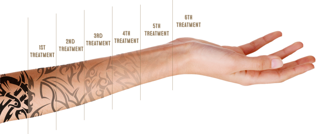 Tattoo Removal Progression Arm PNG