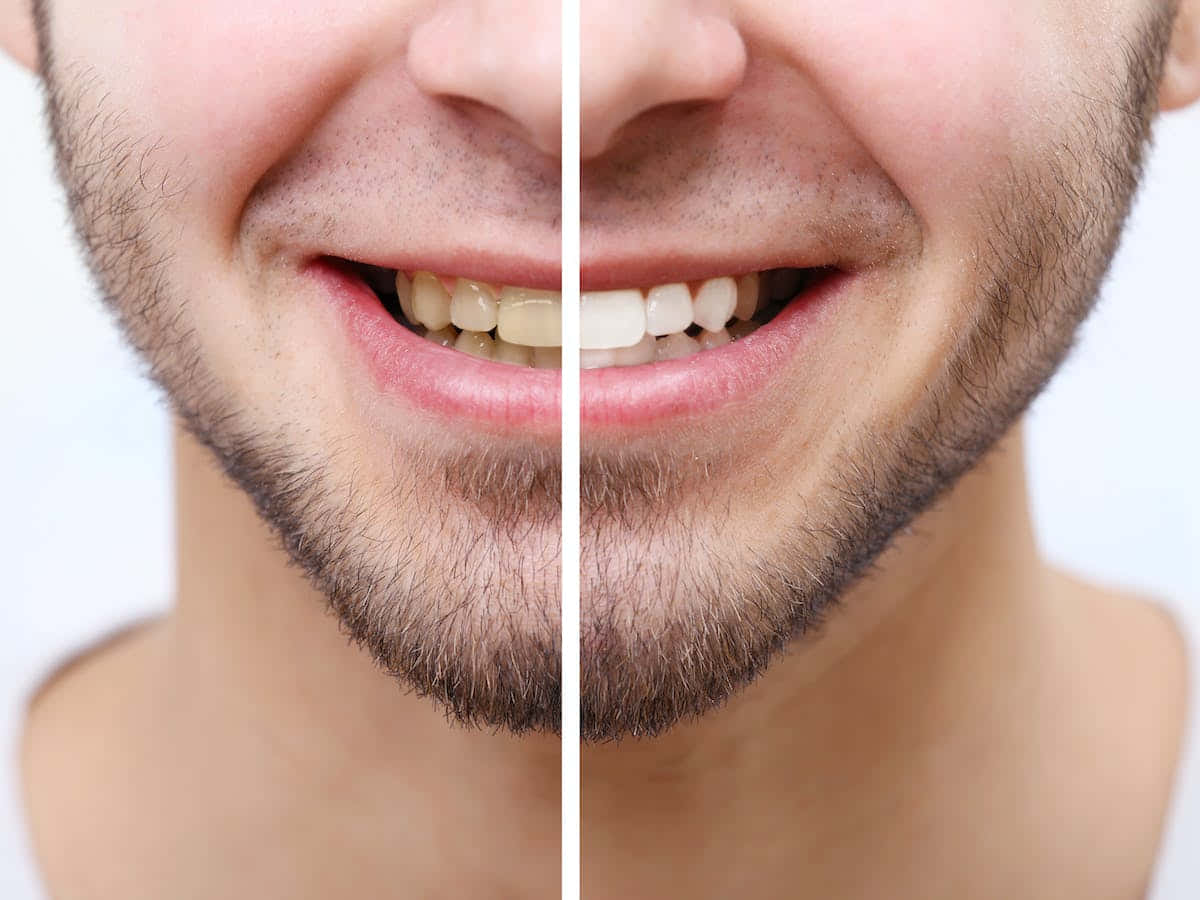 Get That Pearly White Smile With Teeth Whitening Wallpaper