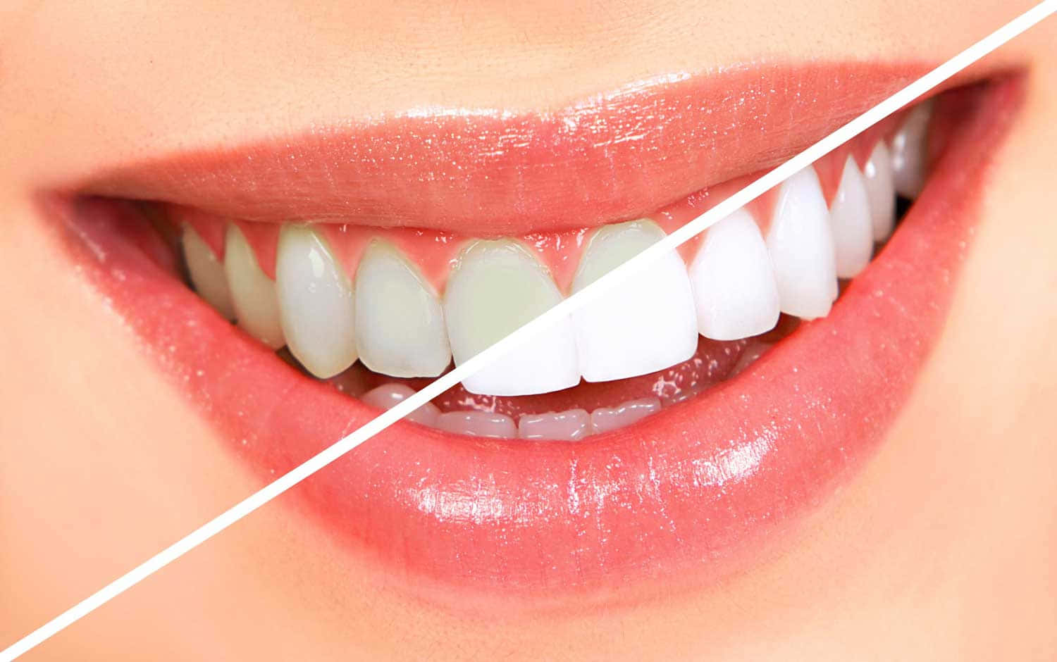 Your perfect smile is just one teeth whitening away Wallpaper