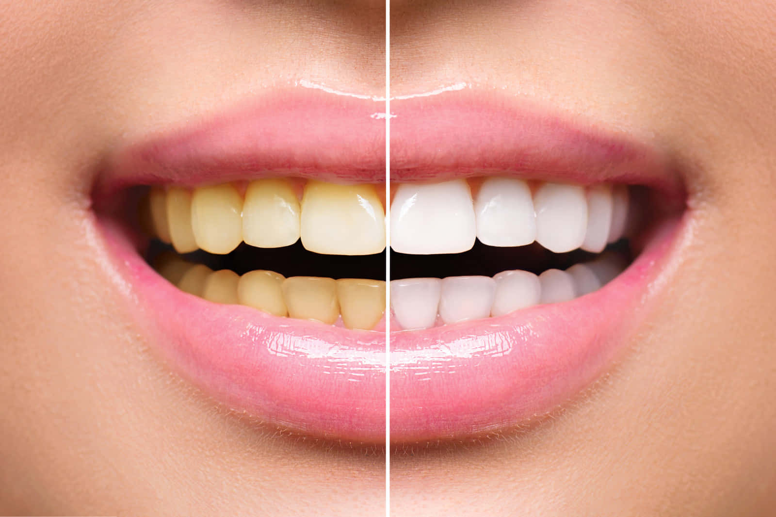 Mejoratu Sonrisa Con Un Tratamiento Profesional De Blanqueamiento Dental. Fondo de pantalla