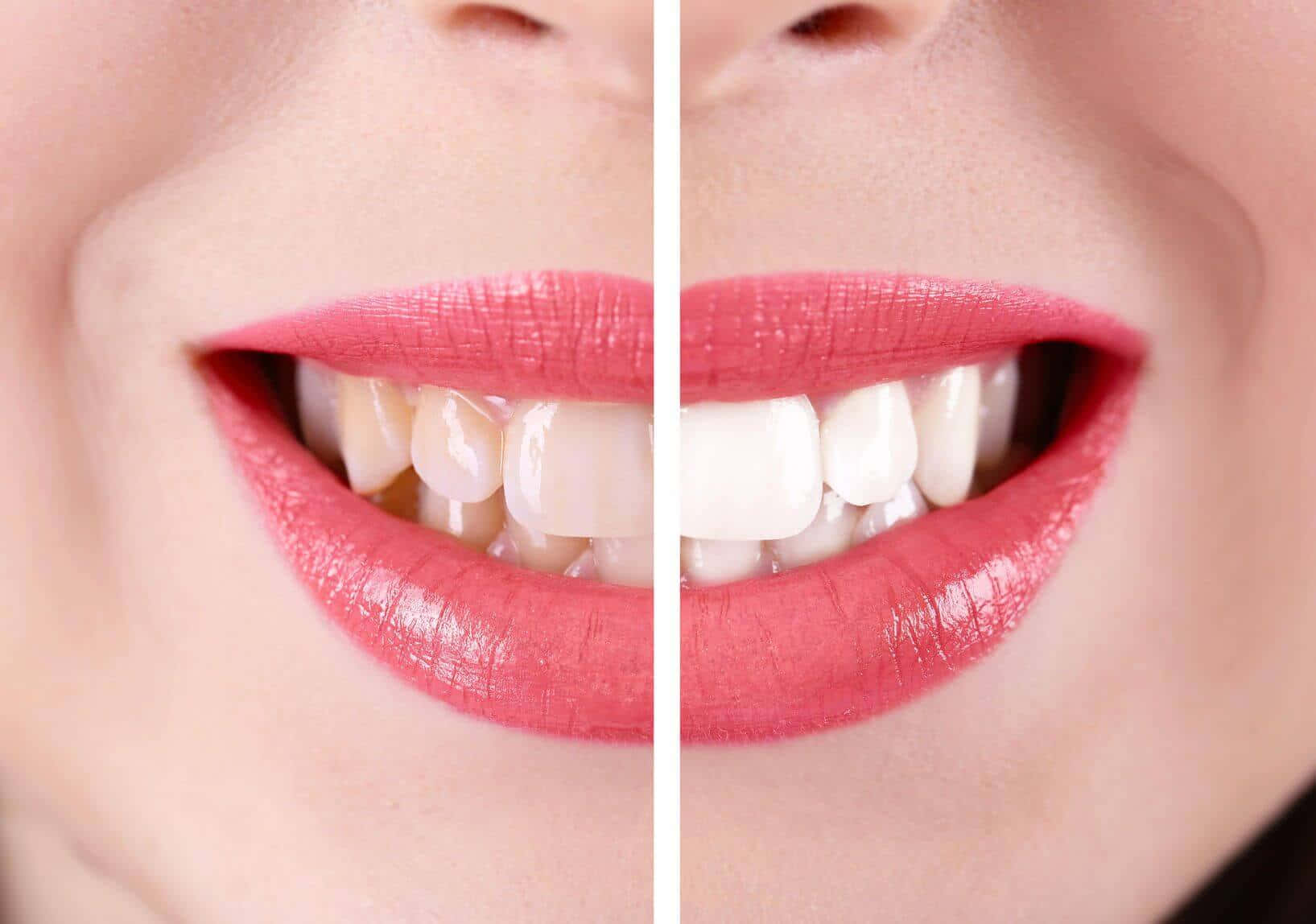 Achieve Your Brightest Smile with Professional Teeth Whitening" Wallpaper