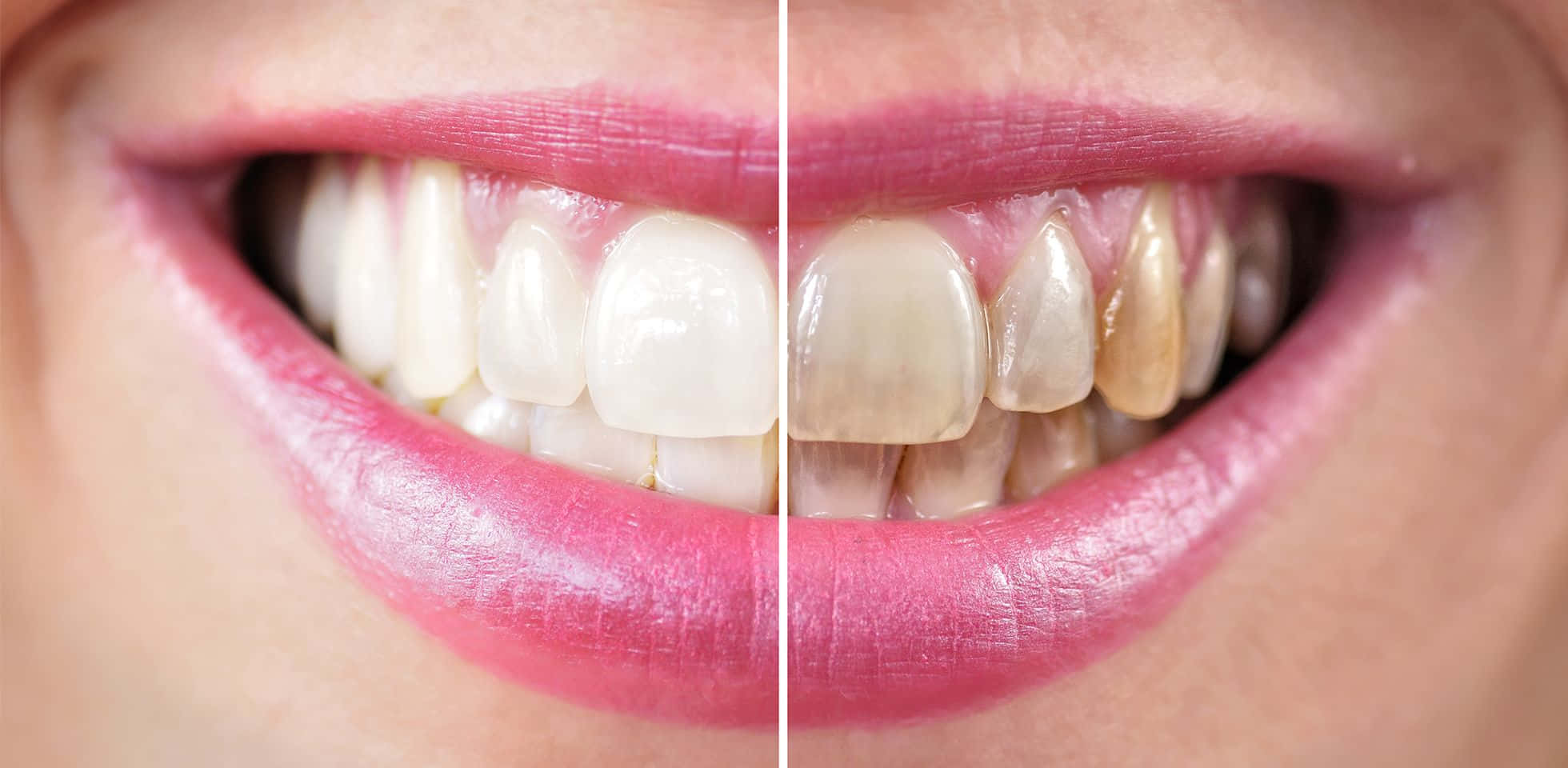 Experience Professional Teeth Whitening Wallpaper