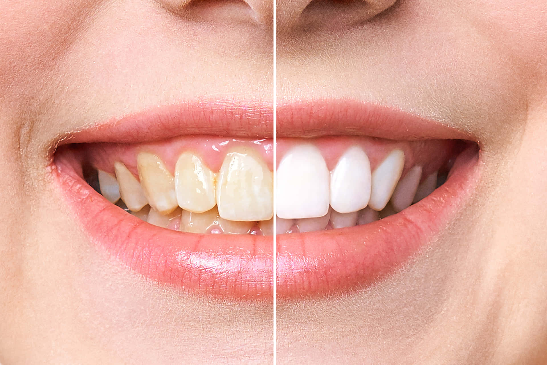 Achieve a Brighter Smile with Teeth Whitening Wallpaper