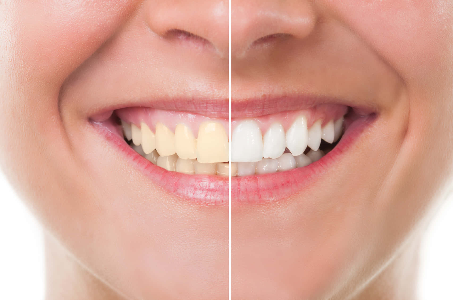 Professional Teeth Whitening for Healthier and Brighter Smile Wallpaper