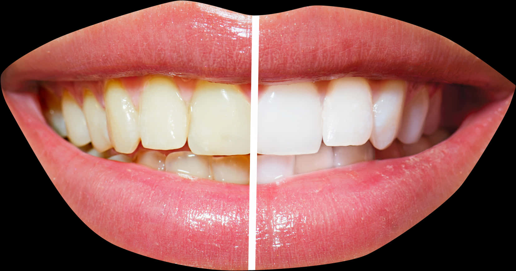Teeth Whitening Comparison Smile.jpg PNG