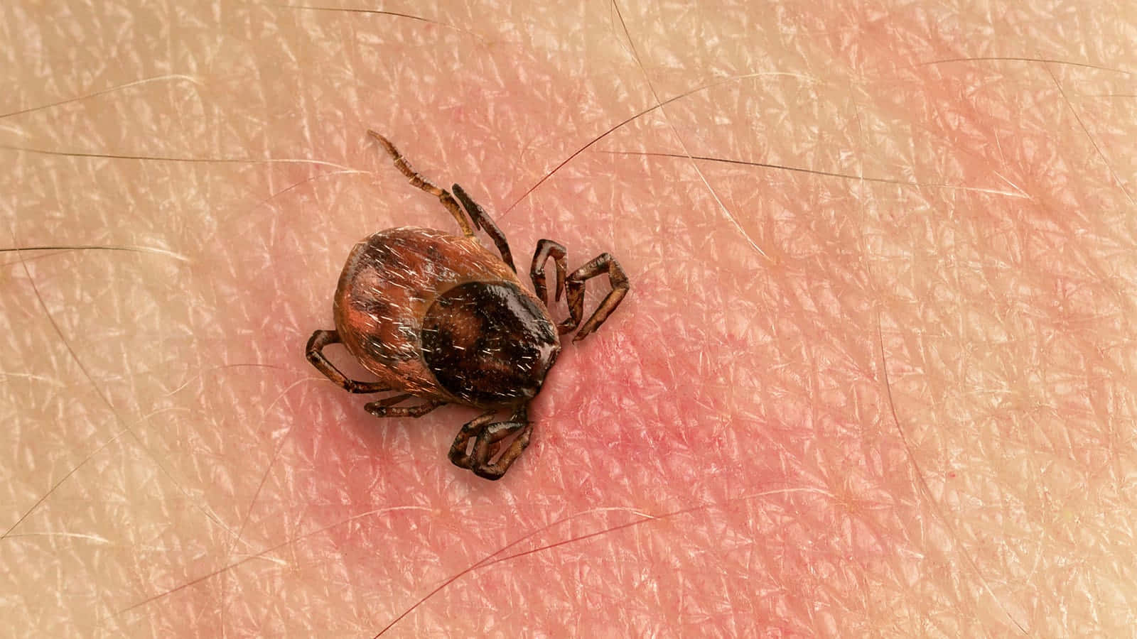 Dead Tick On Skin Pictures