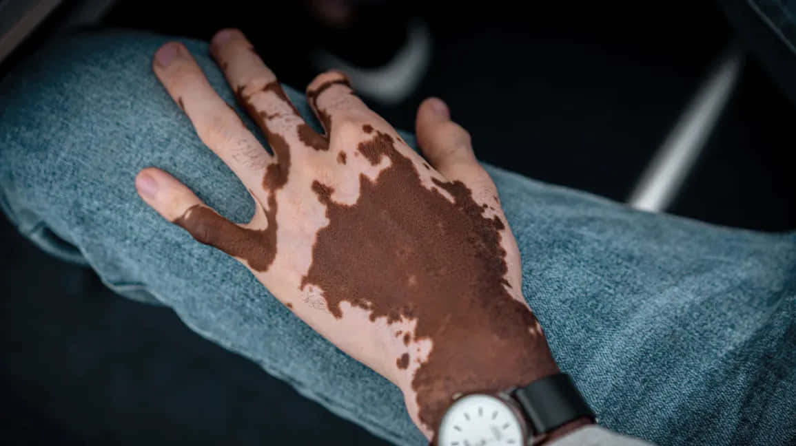 Vitiligo Hand Wrist Watch Wallpaper