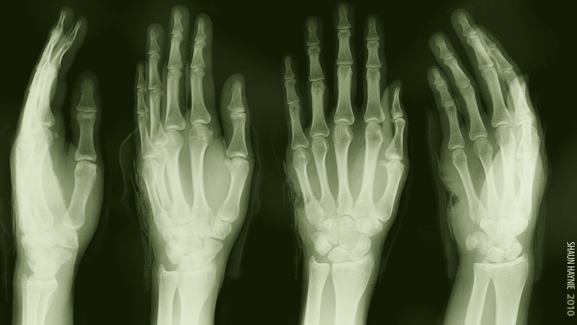 X-rays Of The Hands Of Two People Wallpaper