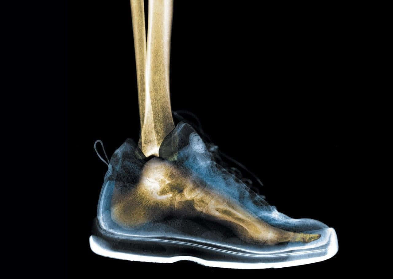 A X - Ray Of A Foot Showing The Bones