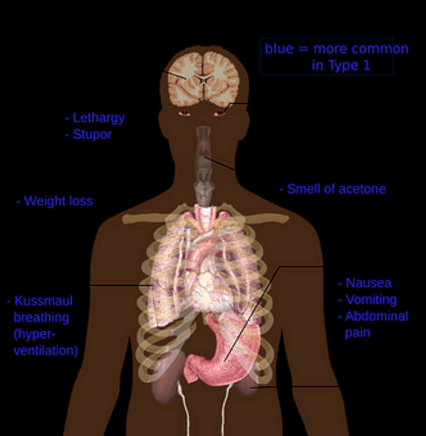 Diabetic Ketoacidosis Symptoms Infographic