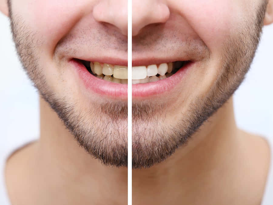 Ottieniquel sorriso bianco perlato con lo sbiancamento dei denti.