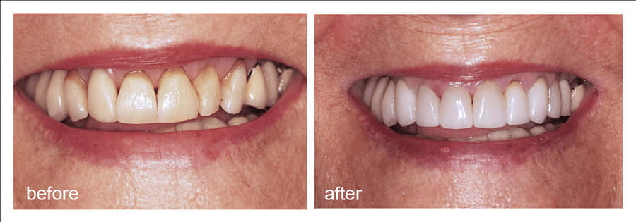 Shot Of Before And After Visiting Abington Smile Gallery - Aggression, HD Png Download