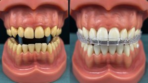 A split view showing crooked teeth before and straight teeth with Invisalign after treatment.