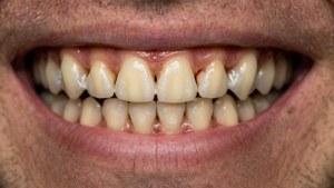 Nærbilde av tenner etter fjerning av aligners, som fremhever fremgang med mellomrom og retting.